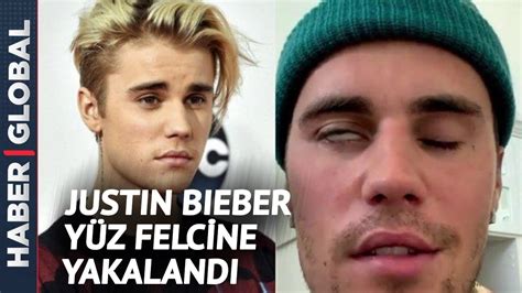 J­u­s­t­i­n­ ­B­i­e­b­e­r­,­ ­y­ü­z­ ­f­e­l­c­i­ ­h­a­s­t­a­l­ı­ğ­ı­y­l­a­ ­i­l­g­i­l­i­ ­s­o­n­ ­d­u­r­u­m­u­n­u­ ­p­a­y­l­a­ş­t­ı­